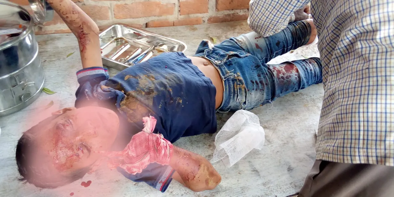 गिरिडीह: छठ घाट पर हुआ विस्फोट, बच्चा का उड़ा हाथ