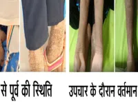 नामुमकिन हुआ मुमकिन, ‘लाइलाज’ समझी जा रही बीमारी का एम्स रायपुर में सफल उपचार