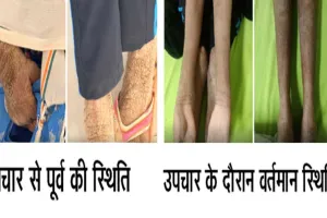 नामुमकिन हुआ मुमकिन, ‘लाइलाज’ समझी जा रही बीमारी का एम्स रायपुर में सफल उपचार